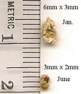 Kidney Stones from January and June of 2011