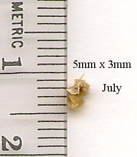 Kidney Stone from July of 2011